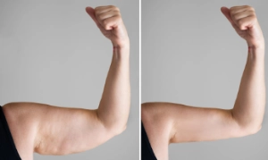 LeptiThin Max Before & After